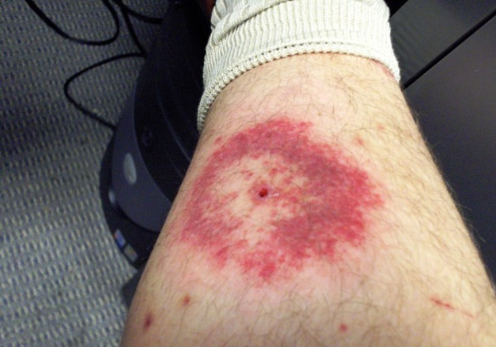 leg with tick bite
